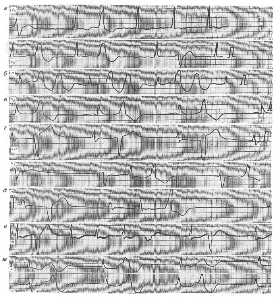 Задание экг. ЭКГ задачи. ЭКГ С ответами. Задачи по ЭКГ С ответами. ЭКГ при ревмокардите.