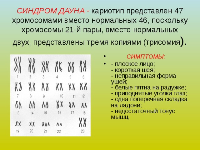 СИНДРОМ ДАУНА - кариотип представлен 47 хромосомами вместо нормальных 46, поскольку хромосомы 21-й пары, вместо нормальных двух, представлены тремя копиями (трисомия ).  СИМПТОМЫ: - плоское лицо;  - короткая шея;  - неправильная форма ушей;  - белые пятна на радужке;  - приподнятые уголки глаз;  - одна поперечная складка на ладони;  - недостаточный тонус мышц. 