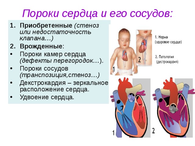 Пороки сердца у детей. Врлдденный порог сержца.