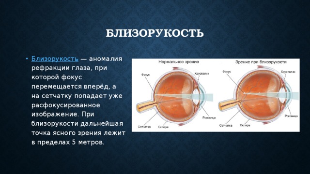 Дополните предложения изображение в близоруком