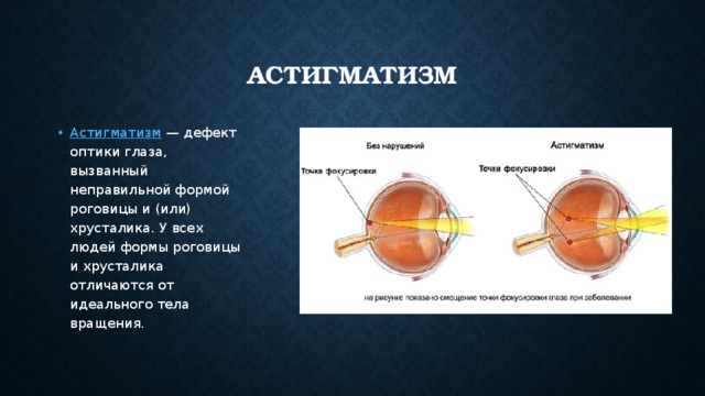 Признаки астигматизма