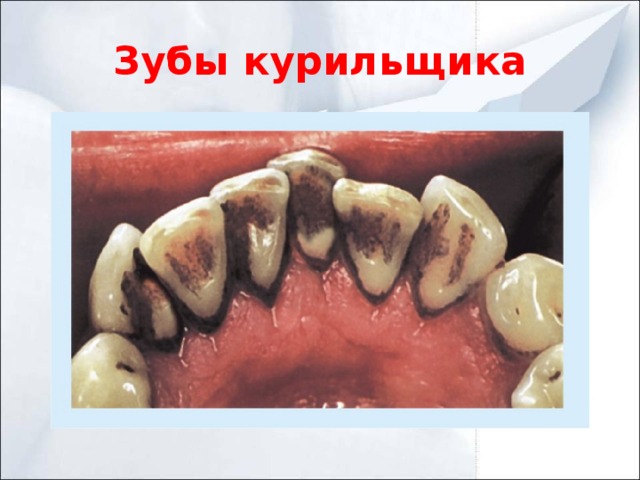 Зубы курильщика
