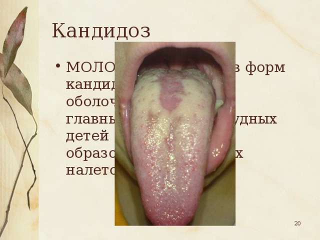 Кандидоз МОЛОЧНИЦА, одна из форм кандидоза слизистой оболочки полости рта, главным образом у грудных детей (покраснение, образование беловатых налетов, язвочек).  
