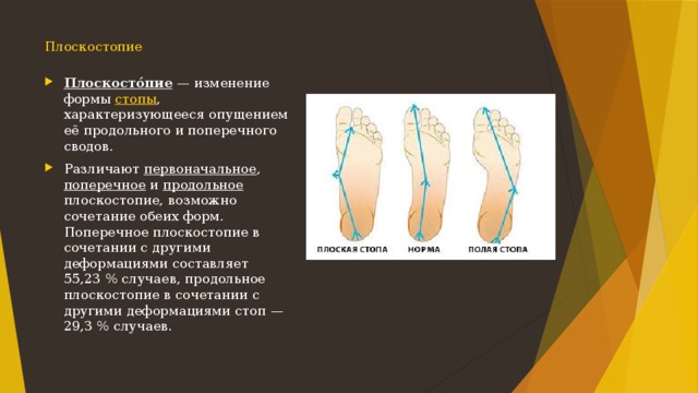 Продольное плоскостопие степени