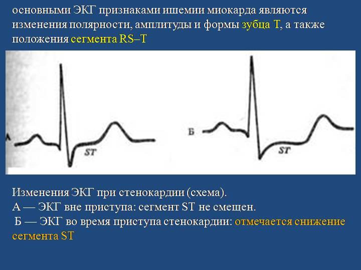 Ишемия боковой стенки на экг