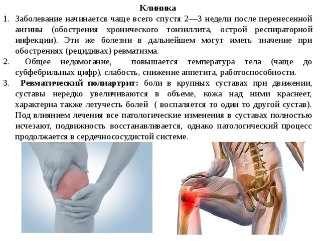 Терапия ревматизм презентация