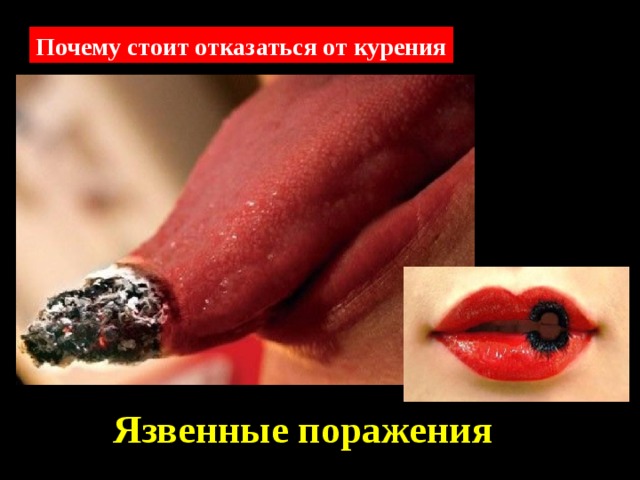 Почему стоит отказаться от курения Язвенные поражения 