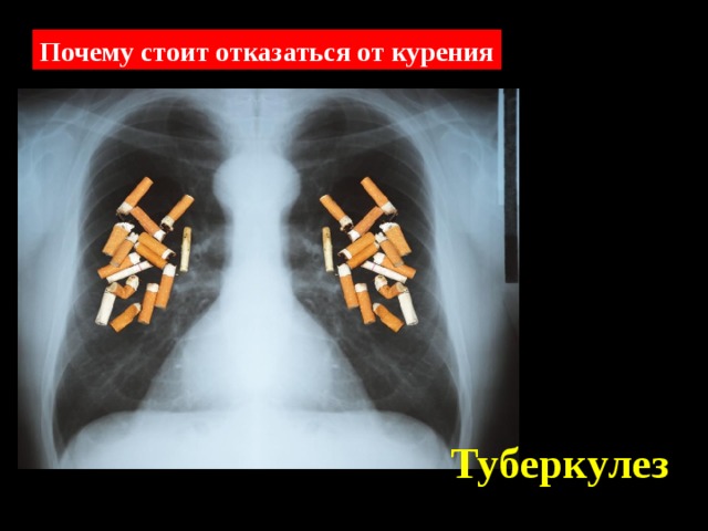 Почему стоит отказаться от курения Туберкулез 