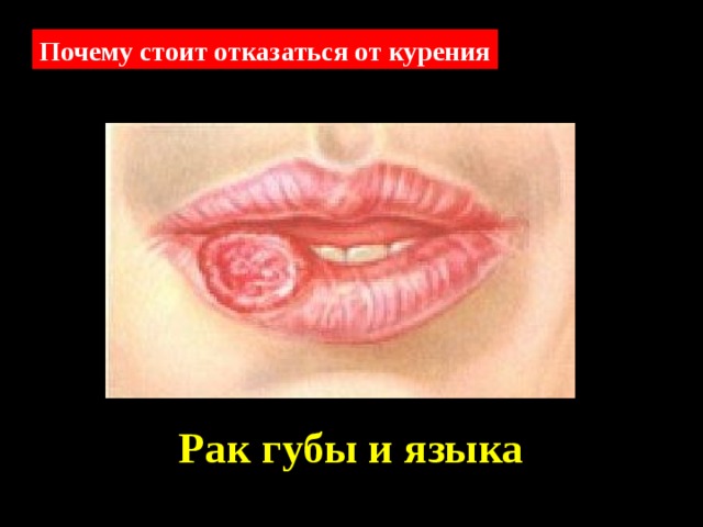 Почему стоит отказаться от курения Рак губы и языка 