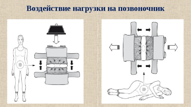 Воздействие нагрузки на позвоночник 