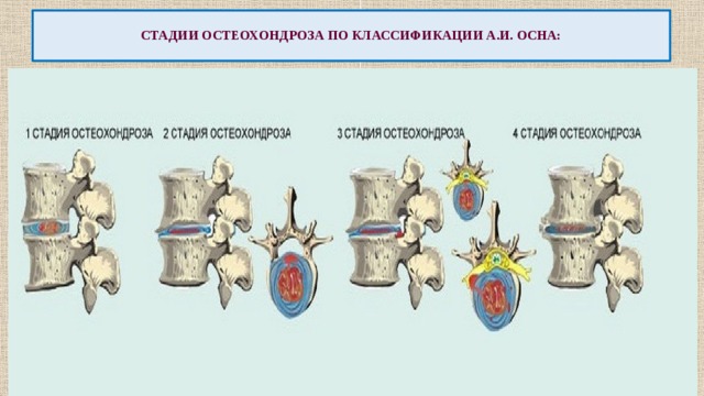  СТАДИИ ОСТЕОХОНДРОЗА ПО КЛАССИФИКАЦИИ А.И. ОСНА:   