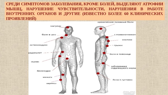 СРЕДИ СИМПТОМОВ ЗАБОЛЕВАНИЯ, КРОМЕ БОЛЕЙ, ВЫДЕЛЯЮТ АТРОФИИ МЫШЦ, НАРУШЕНИЕ ЧУВСТВИТЕЛЬНОСТИ, НАРУШЕНИЯ В РАБОТЕ ВНУТРЕННИХ ОРГАНОВ И ДРУГИЕ (ИЗВЕСТНО БОЛЕЕ 60 КЛИНИЧЕСКИХ ПРОЯВЛЕНИЙ) 