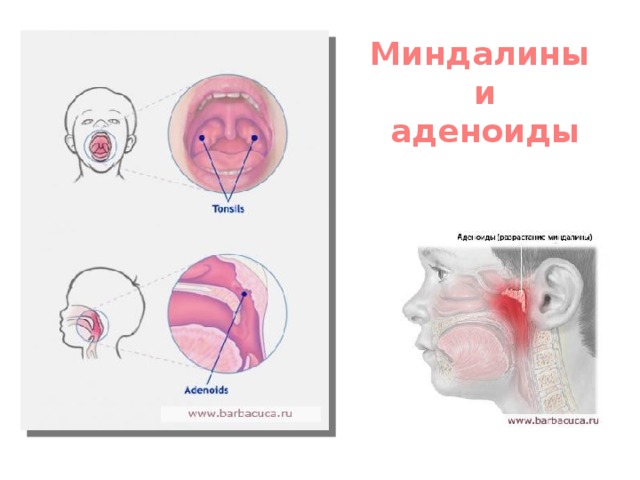 Миндалины  и  аденоиды 