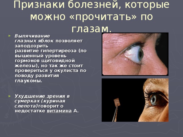 Признаки болезней, которые можно «прочитать» по глазам. Выпячивание глазных яблок  позволяет заподозрить развитие гипертиреоза (повышенный уровень гормонов щитовидной железы), но так же стоит провериться у окулиста по поводу развития глаукомы. Ухудшение зрения  в сумерках (куриная слепота) говорит о недостатке  витамина  А. 