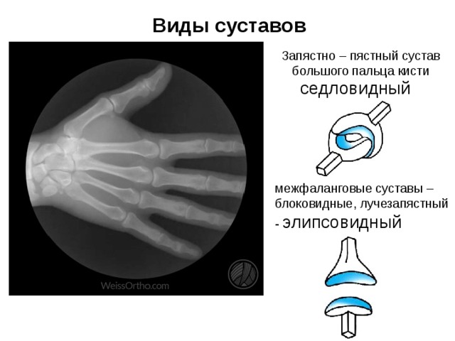 Дистальные межфаланговые суставы кисти фото