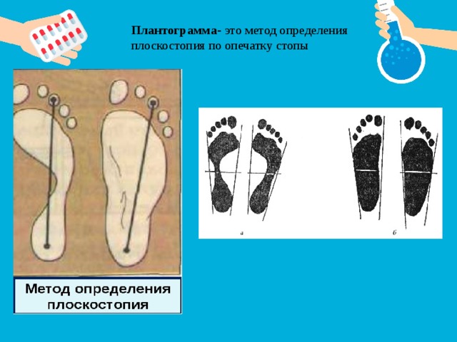 Осанка и плоскостопие. Выявление плоскостопия биология. Способы выявления плоскостопия. Лабораторная плоскостопие. Лабораторная работа выявление плоскостопия.