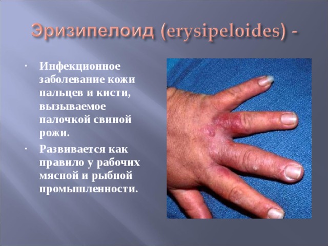 Инфекционное заболевание кожи пальцев и кисти, вызываемое палочкой свиной рожи. Развивается как правило у рабочих мясной и рыбной промышленности. 