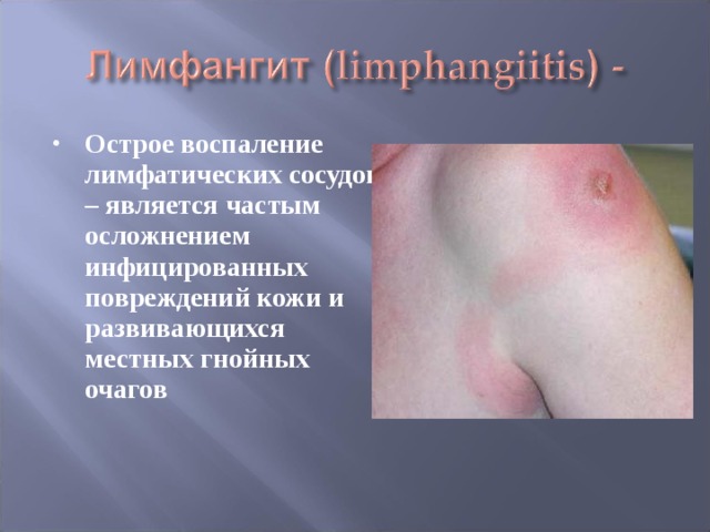 Острое воспаление лимфатических сосудов – является частым осложнением инфицированных повреждений кожи и развивающихся местных гнойных очагов 