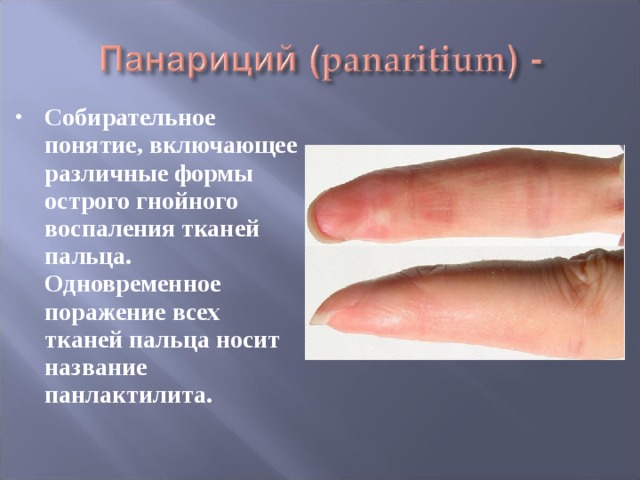 Собирательное понятие, включающее различные формы острого гнойного воспаления тканей пальца. Одновременное поражение всех тканей пальца носит название панлактилита. 