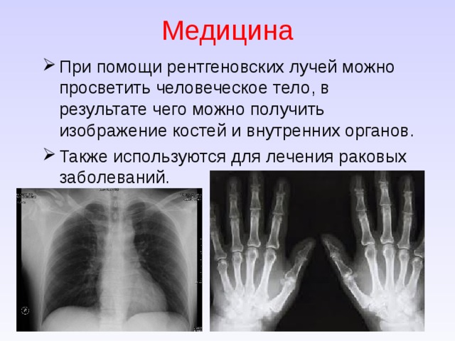 Медицина При помощи рентгеновских лучей можно просветить человеческое тело, в результате чего можно получить изображение костей и внутренних органов. Также используются для лечения раковых заболеваний. 