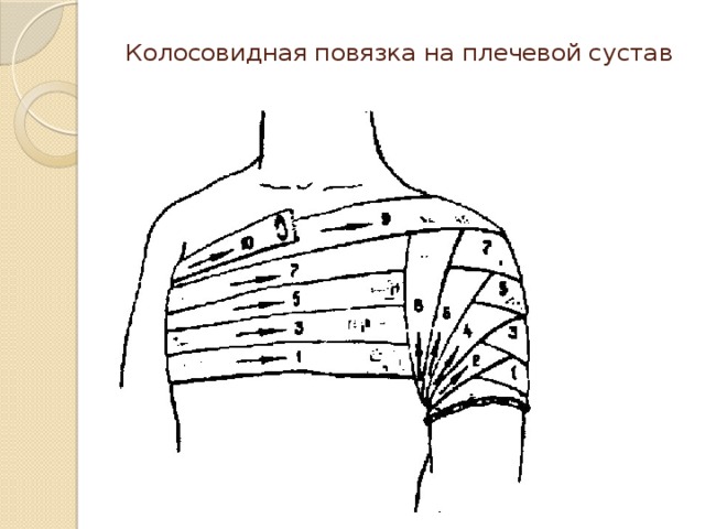 Колосовидная повязка на плечевой сустав 