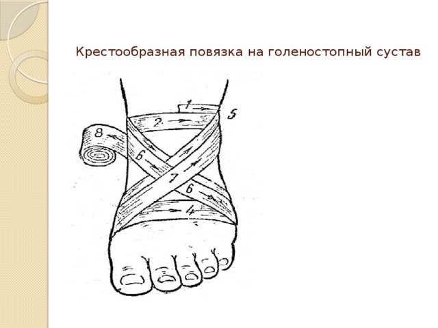 Крестообразная повязка на голеностопный сустав 