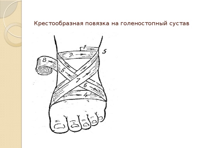 Крестообразная повязка на голеностопный сустав     