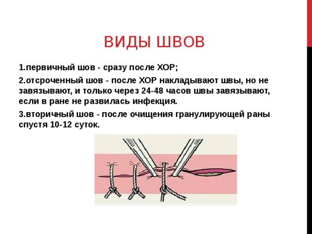 Виды швов 1.первичный шов - сразу после ХОР; 2.отсроченный шов - после ХОР накладывают швы, но не завязывают, и только через 24-48 часов швы завязывают, если в ране не развилась инфекция. 3.вторичный шов - после очищения гранулирующей раны спустя 10-12 суток.  