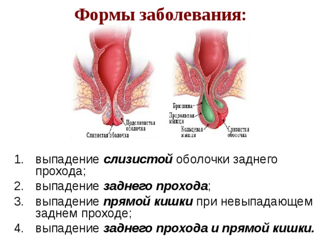 Выпадение узлов при геморрое как