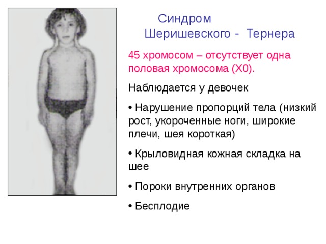 Синдром Шеришевского - Тернера 45 хромосом – отсутствует одна половая хромосома (Х0). Наблюдается у девочек  Нарушение пропорций тела (низкий рост, укороченные ноги, широкие плечи, шея короткая)  Крыловидная кожная складка на шее  Пороки внутренних органов  Бесплодие 