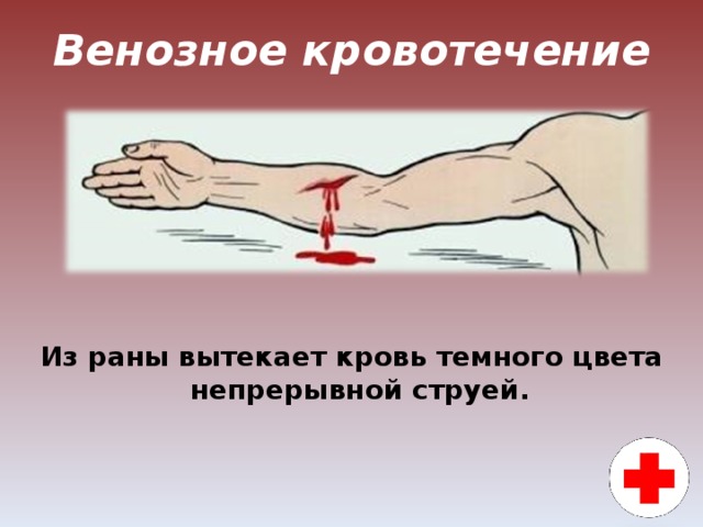 Венозное кровотечение Из раны вытекает кровь темного цвета непрерывной струей.  