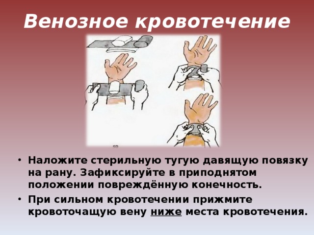 При венозном кровотечении какую наложить повязку. Давящую повязку накладывают при кровотечении из. При венозном кровотечении. Наложить тугую стерильную давящую повязку. При венозном кровотечении накладывают повязку.