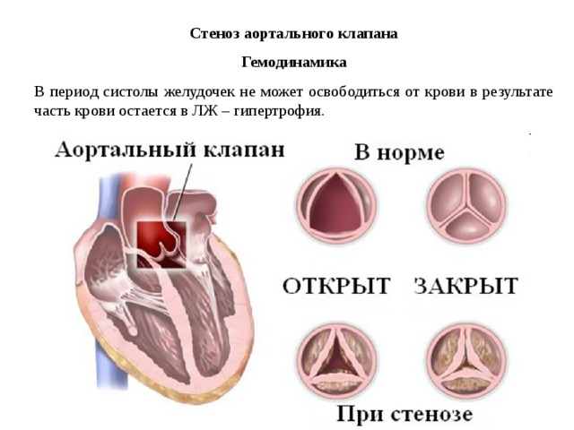 Стеноз аортального клапана Гемодинамика В период систолы желудочек не может освободиться от крови в результате часть крови остается в ЛЖ – гипертрофия. 