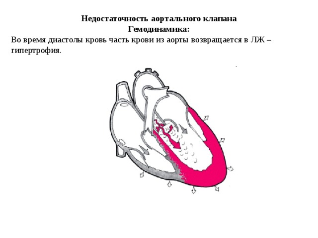 Стеноз устья аорты гемодинамика схема