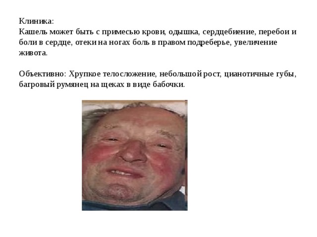 Клиника: Кашель может быть с примесью крови, одышка, сердцебиение, перебои и боли в сердце, отеки на ногах боль в правом подреберье, увеличение живота. Объективно: Хрупкое телосложение, небольшой рост, цианотичные губы, багровый румянец на щеках в виде бабочки. 