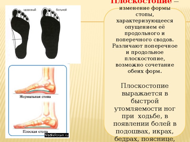 Положение стоп. Упражнения для продольно поперечного плоскостопия. Изменение формы стопы характеризующееся опущением её сводов. Походка при поперечном плоскостопии. Продольно поперечное плоскостопие обеих стоп.