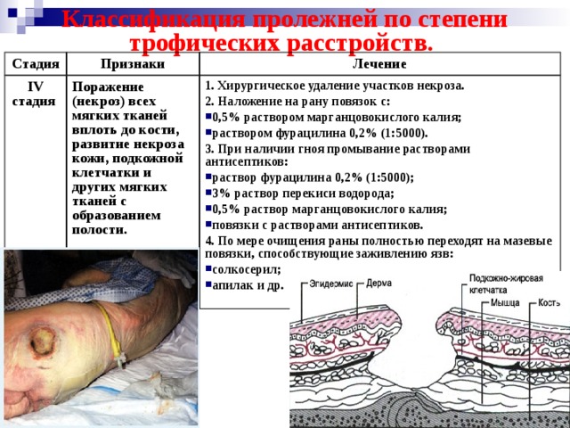 Пролежни 4 степени фото