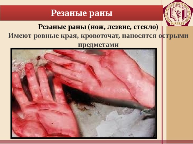 Резаные раны Резаные раны (нож, лезвие, стекло) Имеют ровные края, кровоточат, наносятся острыми предметами 