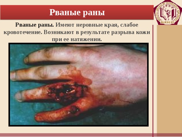 Рваные раны Рваные раны. Имеют неровные края, слабое кровотечение. Возникают в результате разрыва кожи при ее натяжении. 