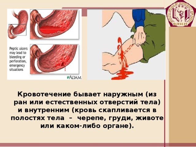 Кровотечение бывает наружным (из ран или естественных отверстий тела) и внутренним (кровь скапливается в полостях тела  –  черепе, груди, животе или каком-либо органе). 