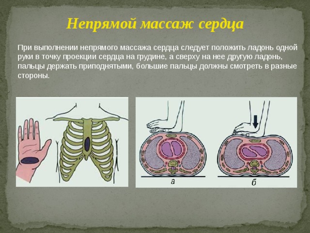 Непрямой массаж сердца При выполнении непрямого массажа сердца следует положить ладонь одной руки в точку проекции сердца на грудине, а сверху на нее другую ладонь, пальцы держать приподнятыми, большие пальцы должны смотреть в разные стороны. 