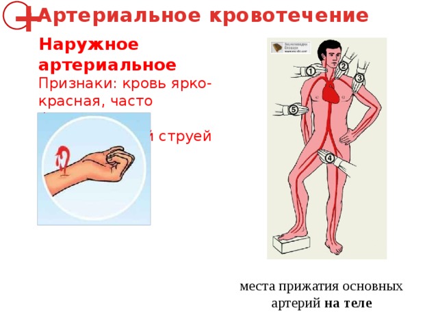 Артериальное кровотечение + Наружное артериальное Признаки: кровь ярко-красная, часто фонтанирует пульсирующей струей места прижатия основных артерий  на   теле 