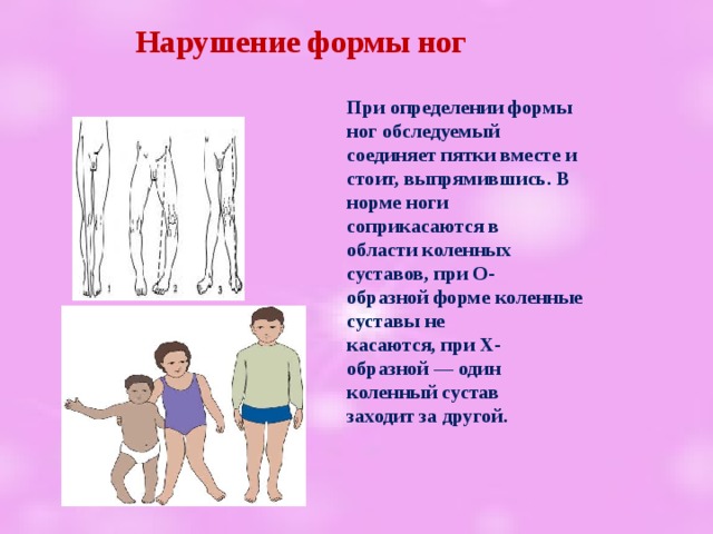 Нарушение формы ног При определении формы ног обследуемый соединяет пятки вместе и стоит, выпрямившись. В норме ноги соприкасаются в области коленных суставов, при О-образной форме коленные суставы не касаются, при Х-образной — один коленный сустав заходит за другой.  