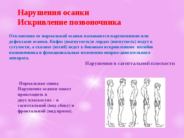 Нарушения осанки Искривление позвоночника Отклонения от нормальной осанки называются нарушениями или дефектами осанки. Кифоз (выгнутость)и лордоз (вогнутость) ведут к сутулости, а сколиоз (изгиб) ведет к боковым искривлениям изгибов позвоночника и функциональные изменения опорно-двигательного аппарата.  Нарушения в сагиттальной плоскости   Нормальная спина Нарушение осанки может происходить в двух плоскостях – в сагиттальной (вид сбоку) и фронтальной (вид прямо). 