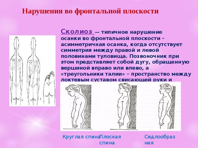 Нарушения во фронтальной плоскости Сколиоз  — типичное нарушение осанки во фронтальной плоскости – асимметричная осанка, когда отсутствует симметрия между правой и левой половинами туловища. Позвоночник при этом представляет собой дугу, обращенную вершиной вправо или влево, а «треугольники талии» – пространство между локтевым суставом свисающей руки и талией – становятся разными в связи с тем, что одно плечо и лопатка опущены  Круглая спина Плоская спина Седлообразная 