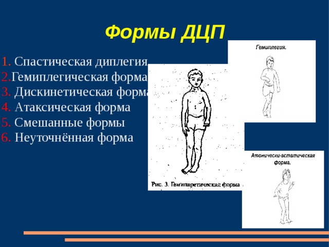 Дцп диплегия. Спастическая диплегия форма ДЦП. Спастический церебральный паралич. Спастическая диплегия нижних конечностей у детей с ДЦП. Спастическая форма ДЦП симптомы.