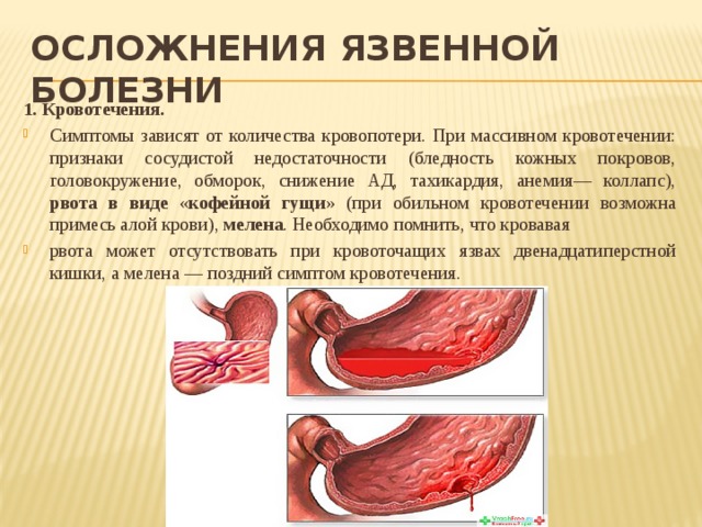 Первый стол при язве двенадцатиперстной кишки