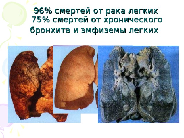 96% смертей от рака легких  75% смертей от хронического бронхита и эмфиземы легких  