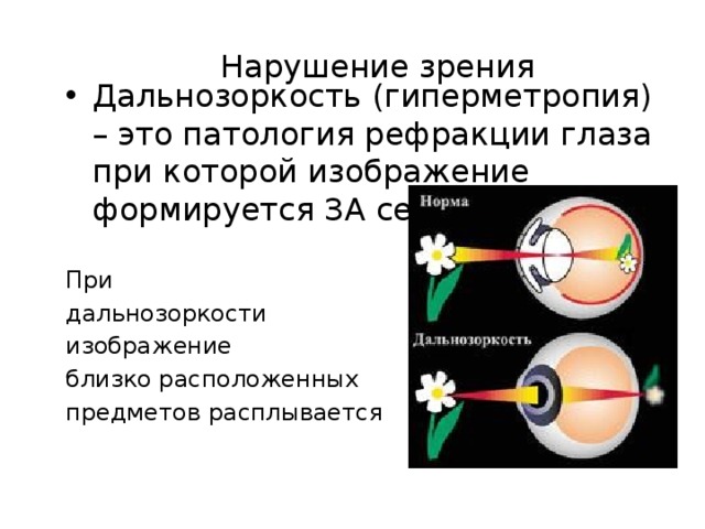 Расположение f оптической системы глаза схема близорукости