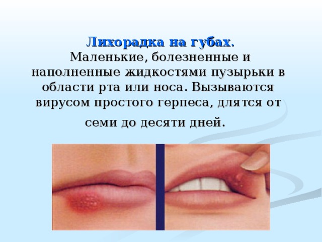   Лихорадка на губах .   Маленькие, болезненные и наполненные жидкостями пузырьки в области рта или носа. Вызываются вирусом простого герпеса, длятся от семи до десяти дней.  